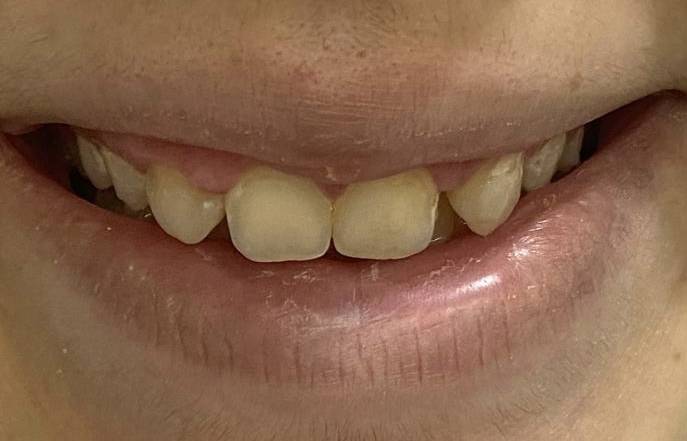 ANTES ANTES